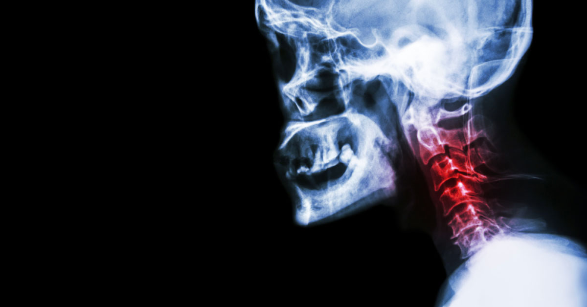Nonoperative Modalities For Treating Symptomatic Cervical Spondylosis