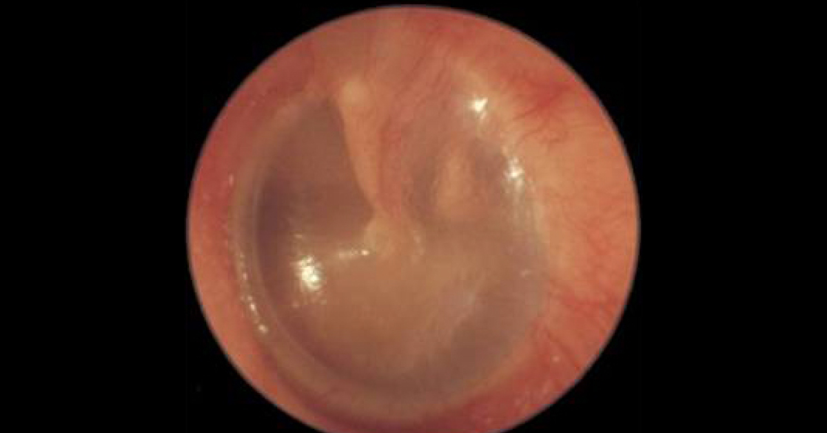 Identify This ENT Condition
