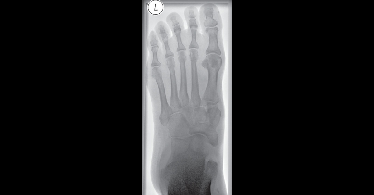 A Case OF Traumatic Injury