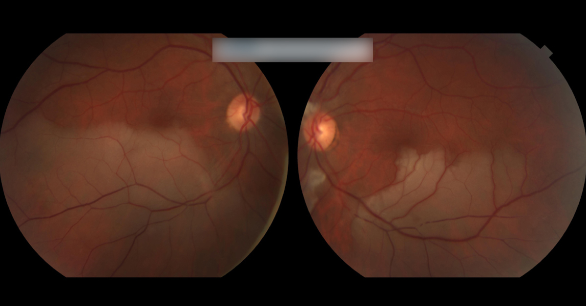 Spot This Ophthalmic Condition