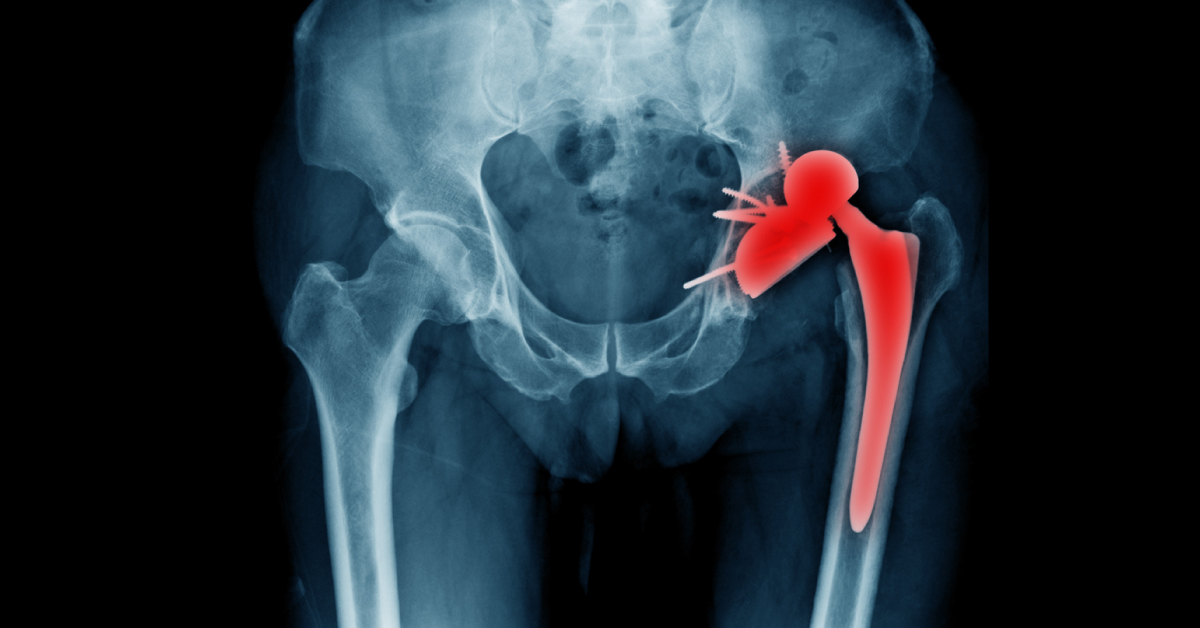 Vascularized Bone Grafts And Length Of The Joint