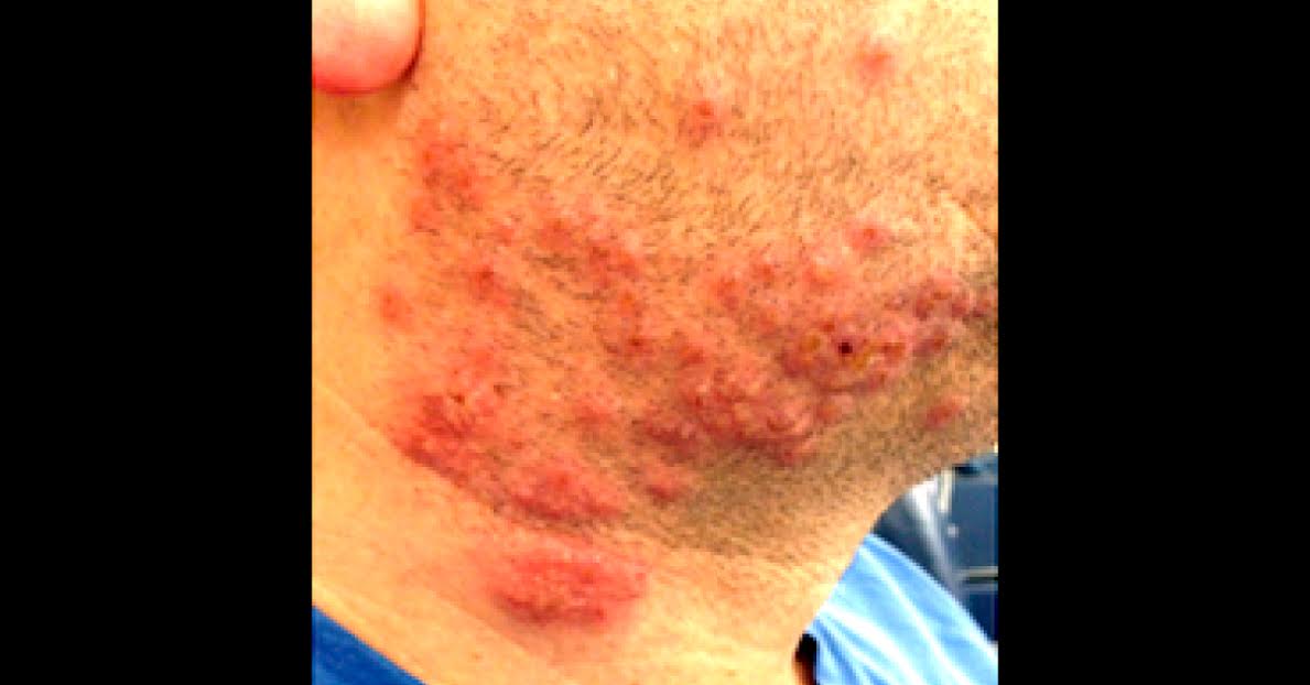Wide Spread Pustules And Vesicles