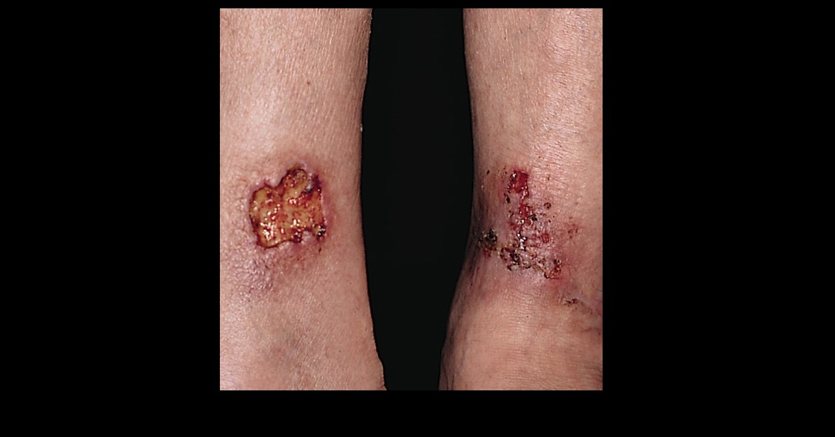 Painful Ulcers On The Legs