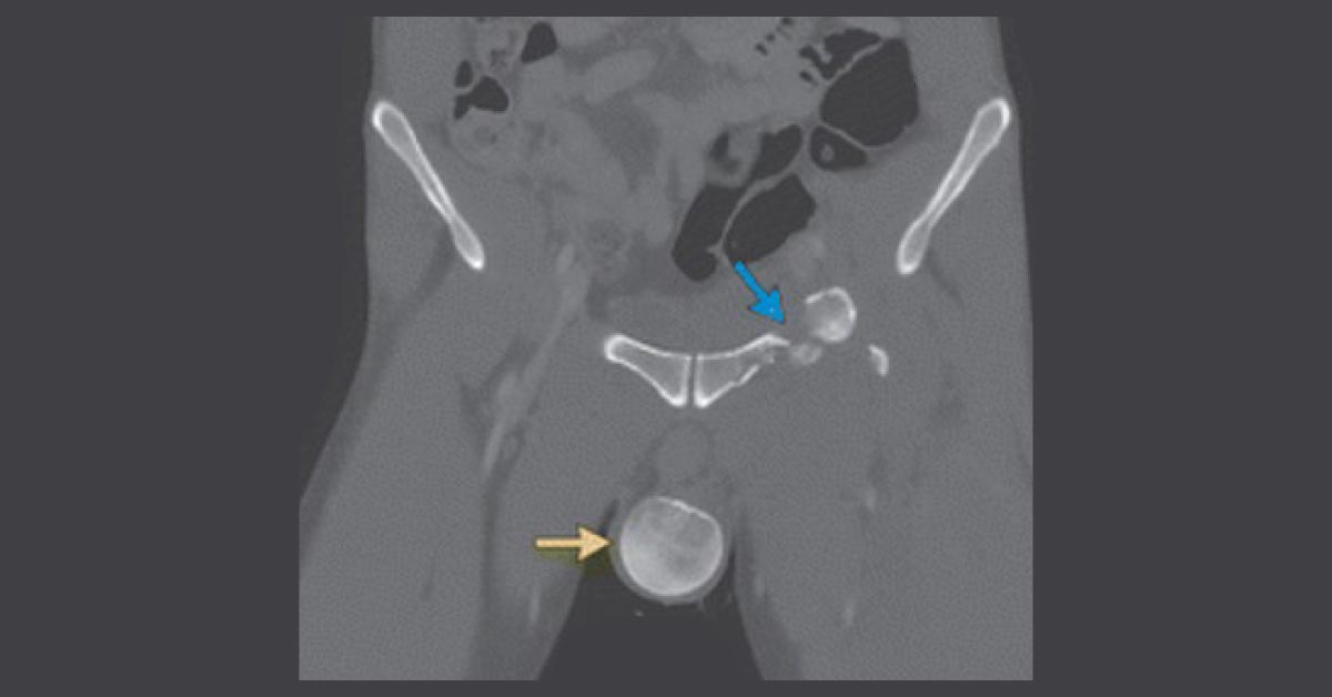 CT Of An Accident Patient, What Does It Show?