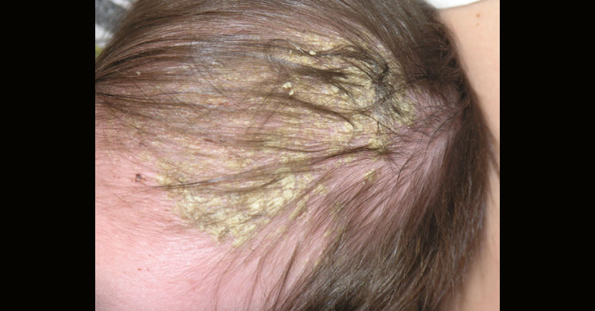 Identify the Dermal Condition