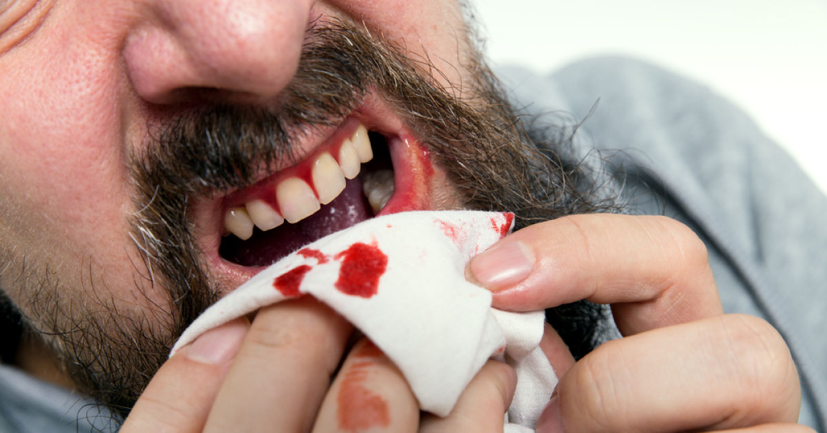 Glanzmann Thrombasthenia, A Inherited Platelet Disorder