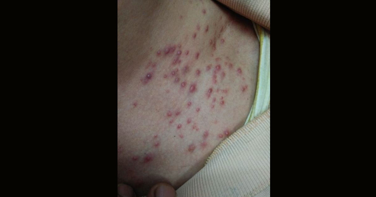 Cause, Diagnosis And Treatment Of Skin Lesion Required.