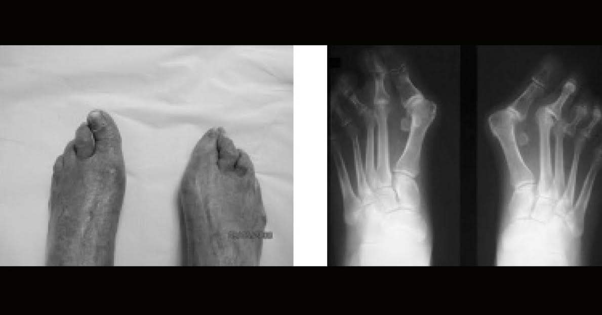 Deformed Feet In An Elderly