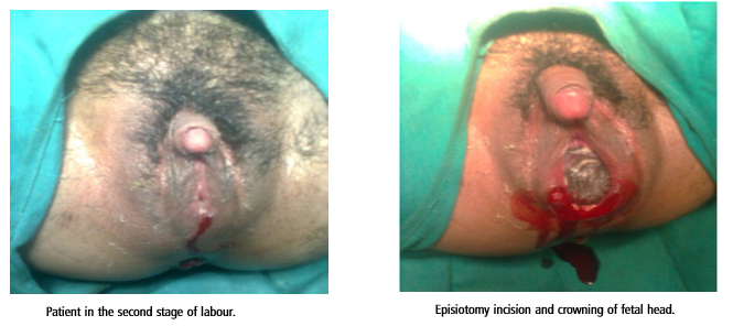 Fertility And Pregnancy Outcome In A Woman With Classic Congenital Adrenal Hyperplasia