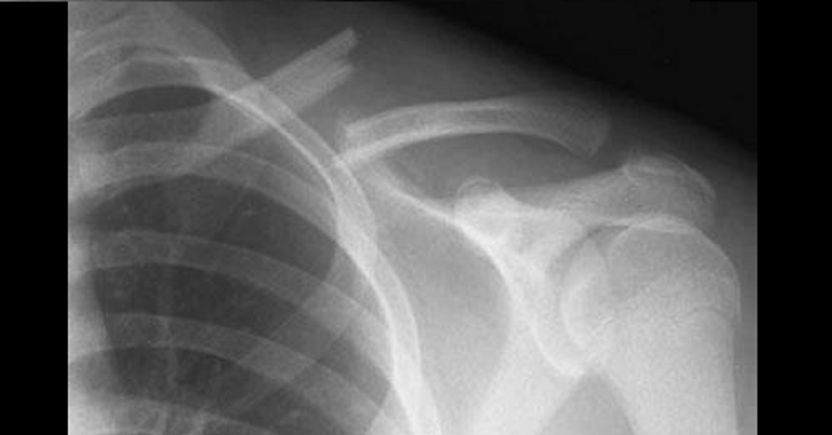 A Painful Collarbone In A Young Male