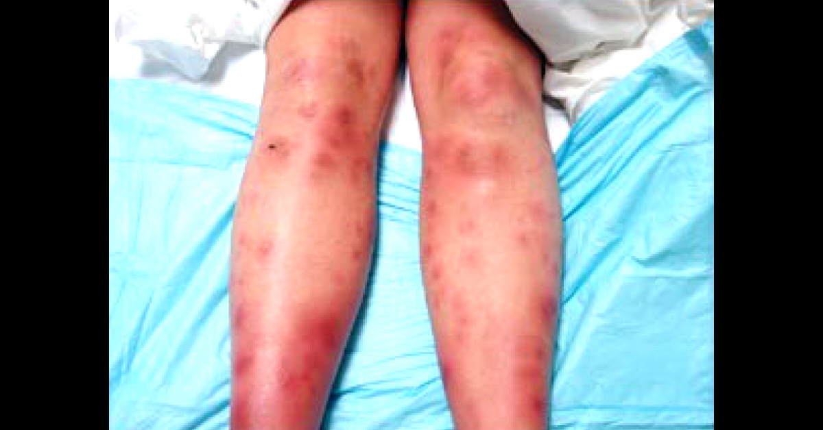 Identify The Dermal Condition