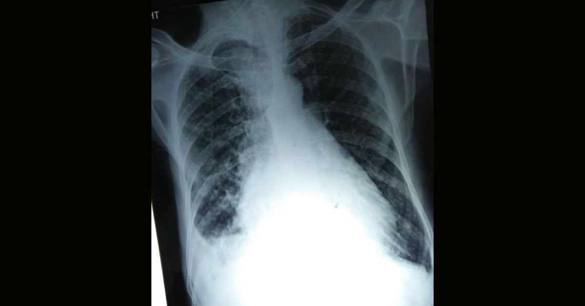 What Defect Is Responsible For All Symptoms And Signs? 