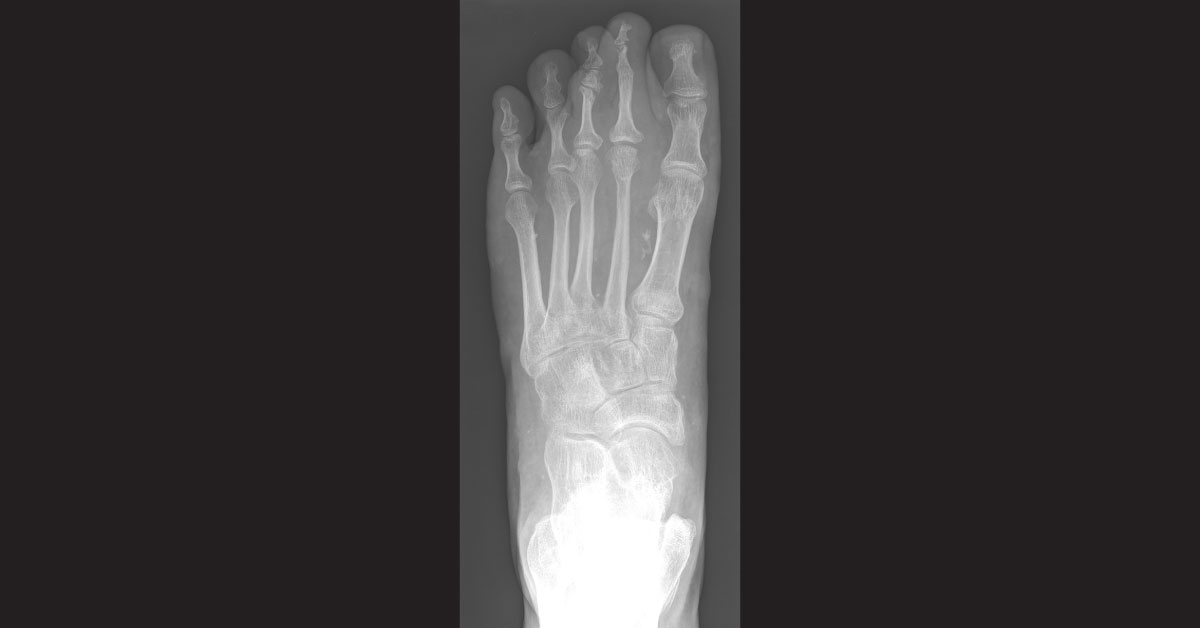 The Case Of Non Healing Foot Ulcer
