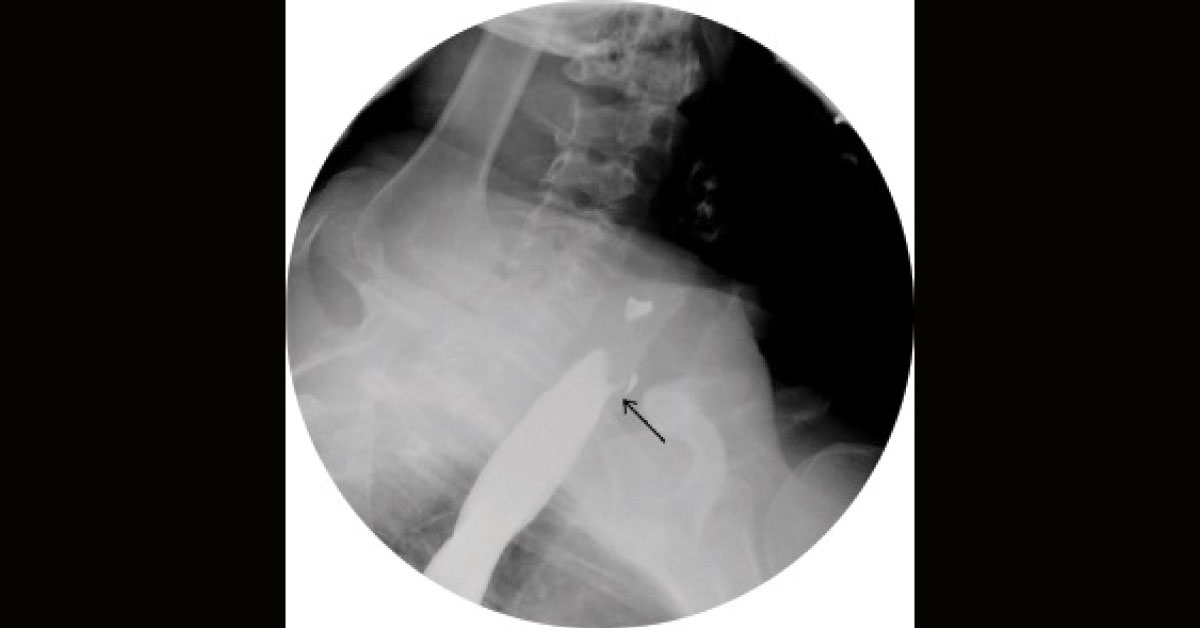 What Is The Diagnosis For Persistent Cough In This Nonsmoker?
