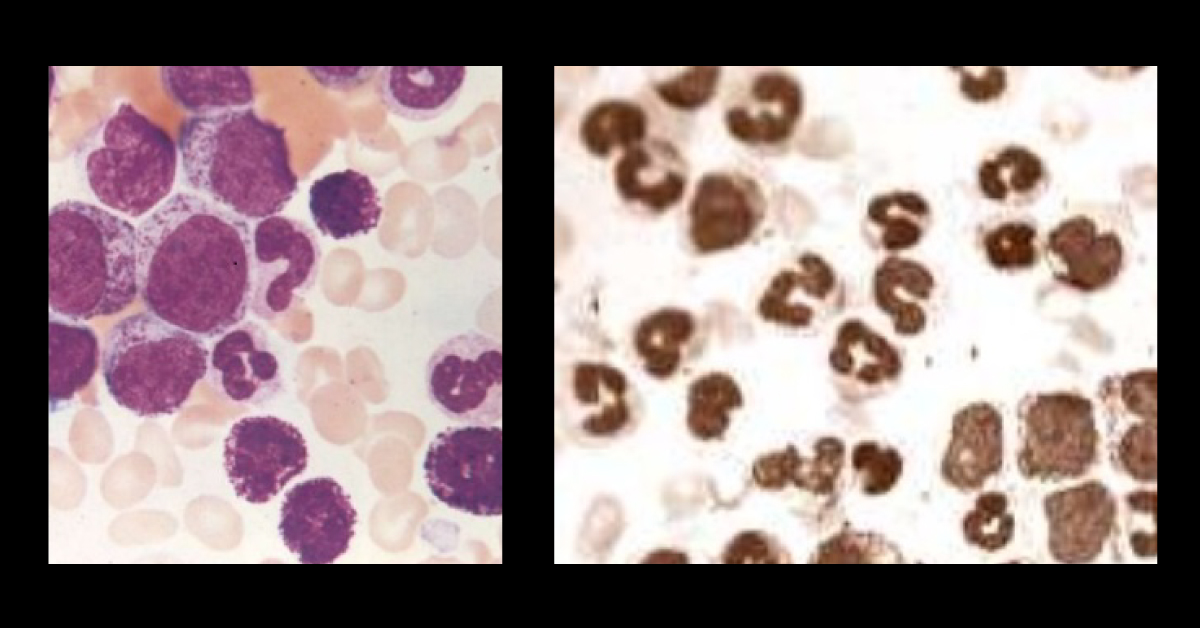 Identify This Condition In A Man With Splenomegaly