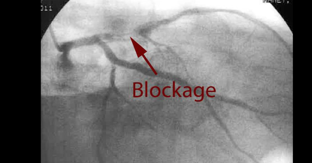 Angiograms Can Be Harmful For Your Health!