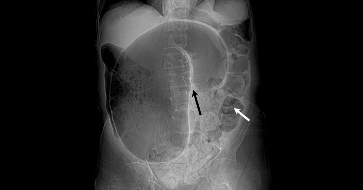 Identify This Condition In A Man Complaining Constipation