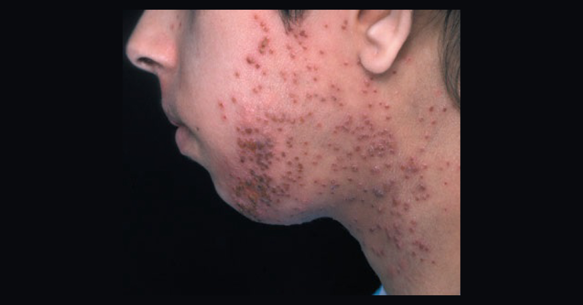 Interpret This Dermatological Condition
