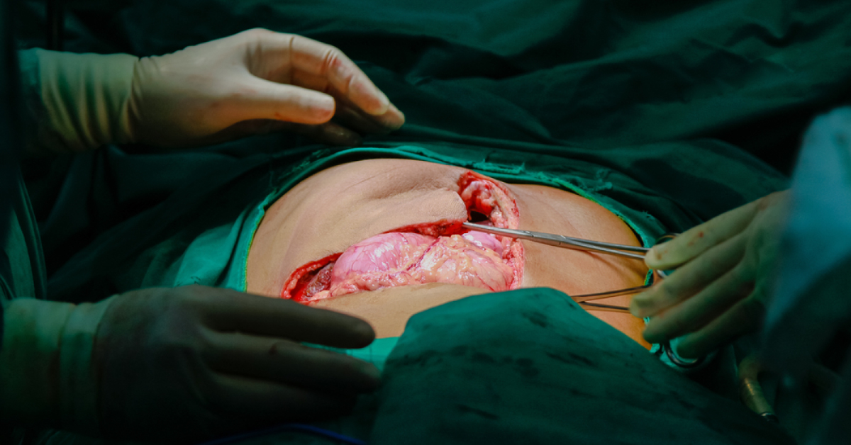 Fighting Cytomegalovirus In Liver Transplant Patients