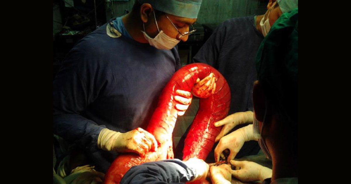 A Case Of Giant Sigmoid Volvulus