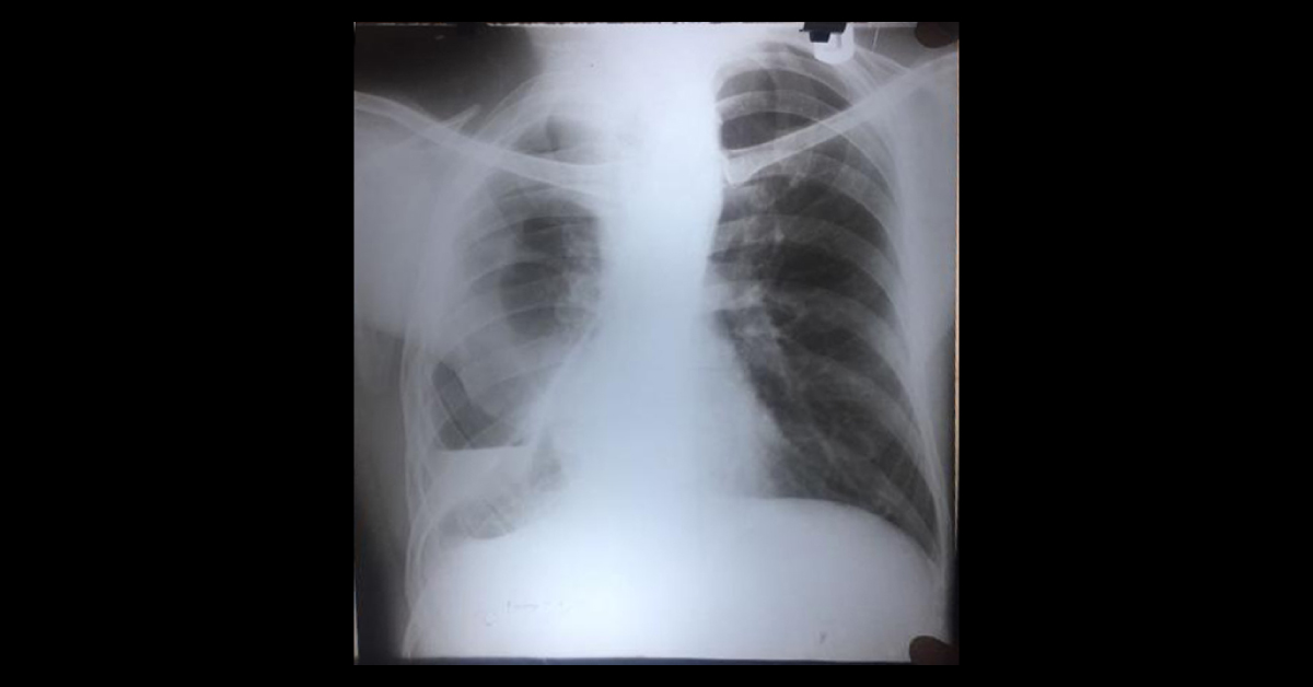 How To Treat This Right Lung Problem