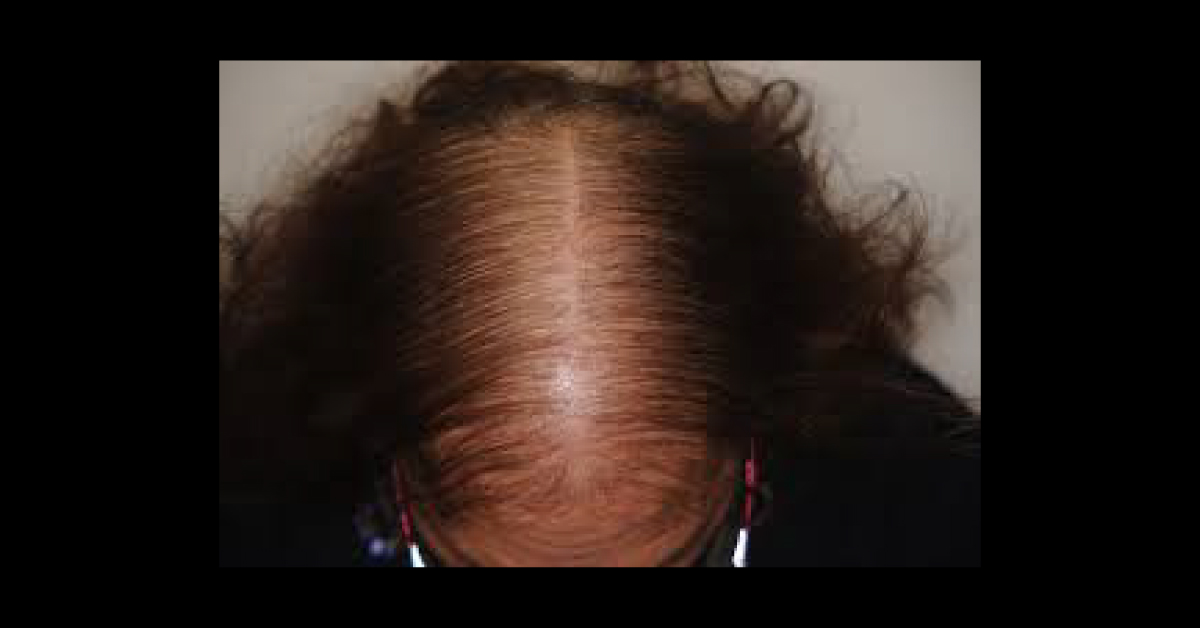 A Case of Hair Thinning