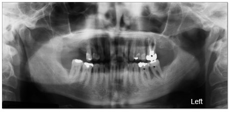 Diagnosis For Left Facial Swelling