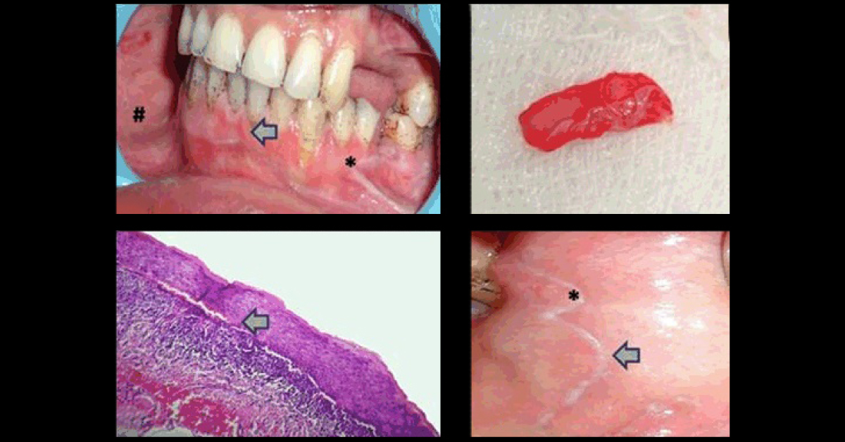 Identify This Inflammatory Condition In An Elderly Man