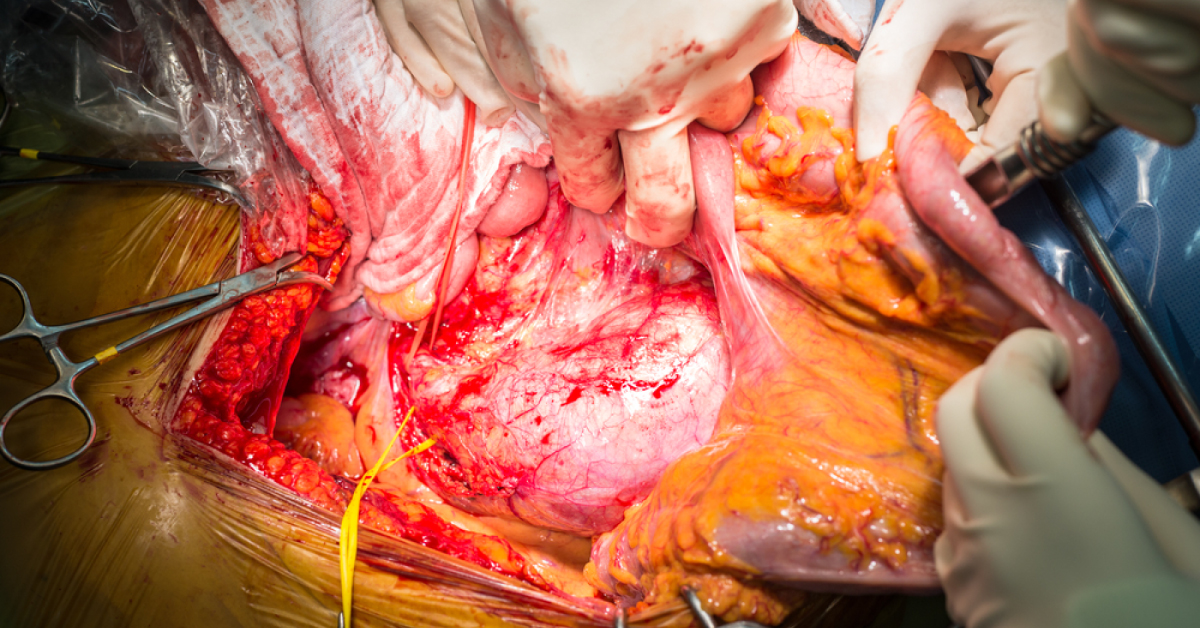Endovascular Stent Grafting: National Institute for Health and Care Excellence