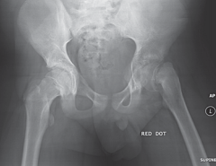 Solve This Case Of Limping Child