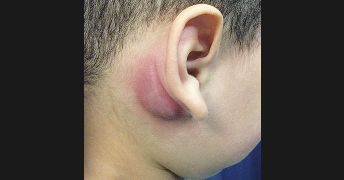 A Pediatric Patient With Painful Ear And Swelling In Postauricular Area
