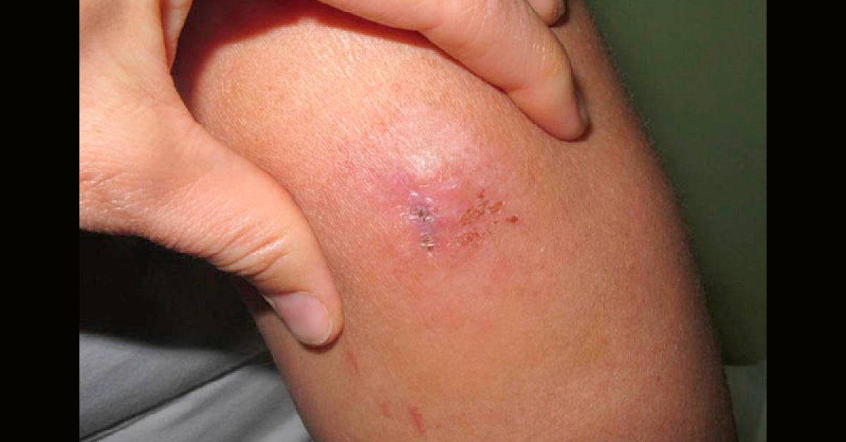 Case Of A Painful Progressive Mass On A Hand