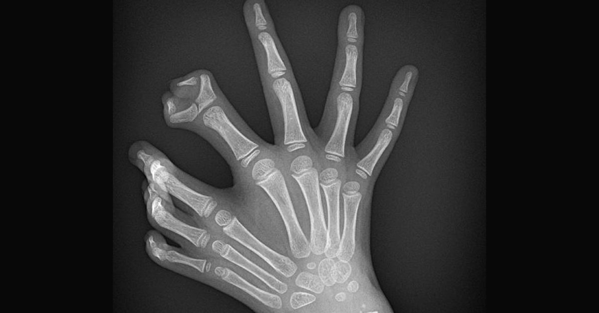 Crack This Rare Congenital Syndrome