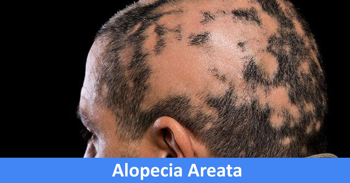 Alopecia Areata: British Journal of Dermatologists (2012)