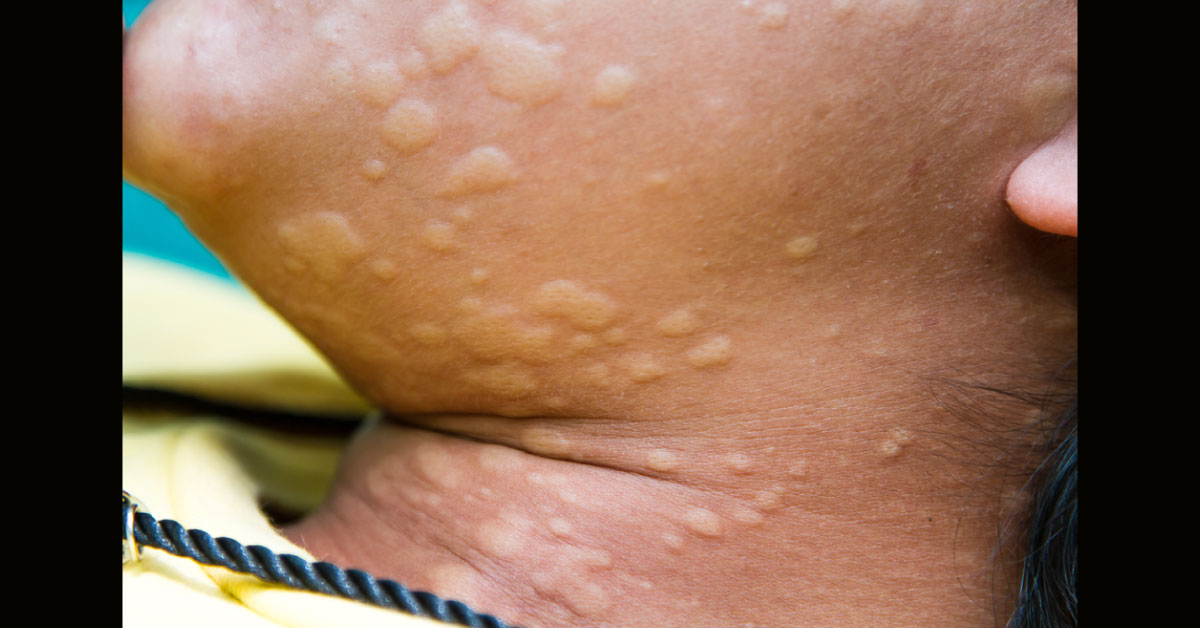 Urticaria Management In Adults And Children