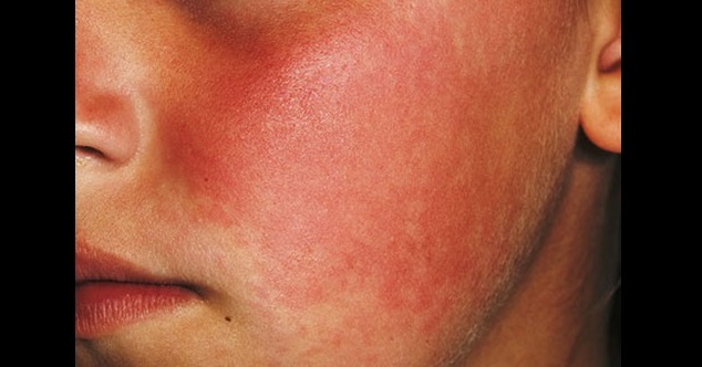 Slapped Cheek Syndrome In Children – An Insight