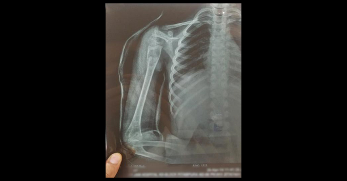 Bone Cyst (Simple / Aneurysmal)