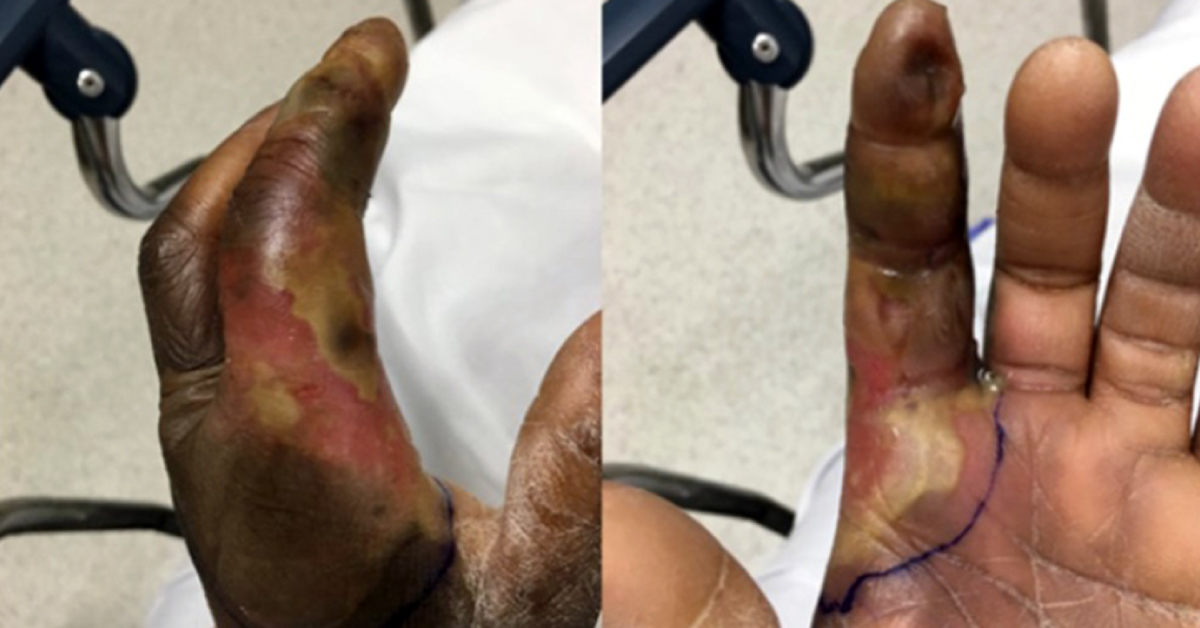 Diagnosis Of A Diabetic Woman With Left Index Finger Pain