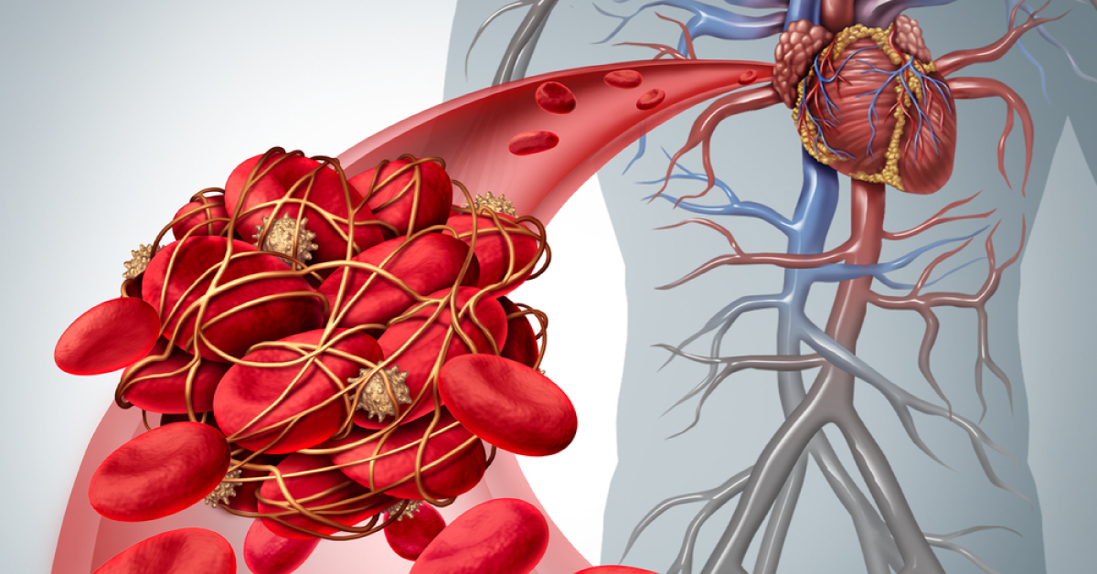 New Type Of "PET Scan" Will Diagnose Thrombus In Heart, Arteries And Veins