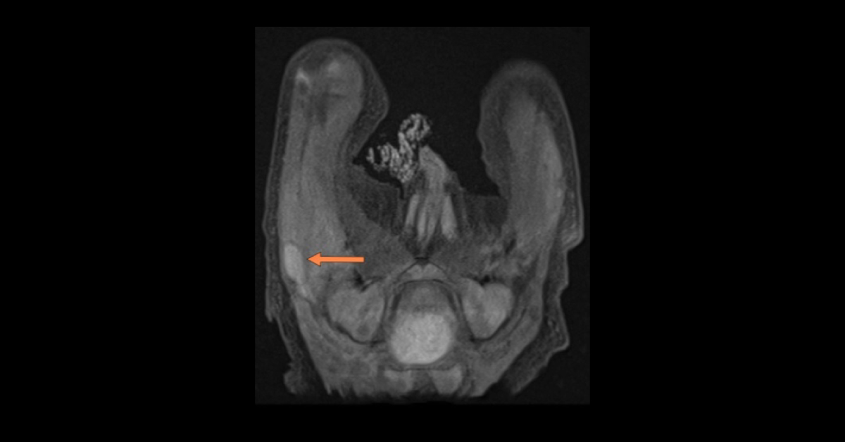 A Pediatric Case Of Worsening Right Leg Pain