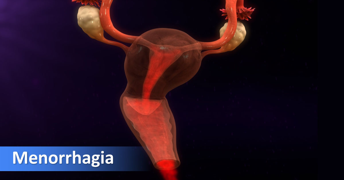 Abnormal Uterine Bleeding Before Menopause Management Guidelines