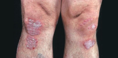 Resolve This Skin Problem