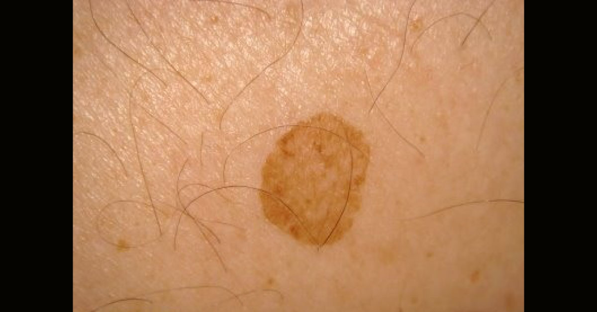 Identify The Dermal Condition
