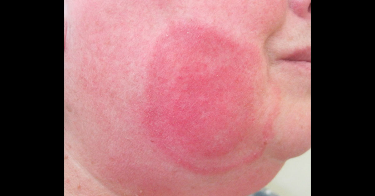 Identify This Progressively Expanding Red Plaque