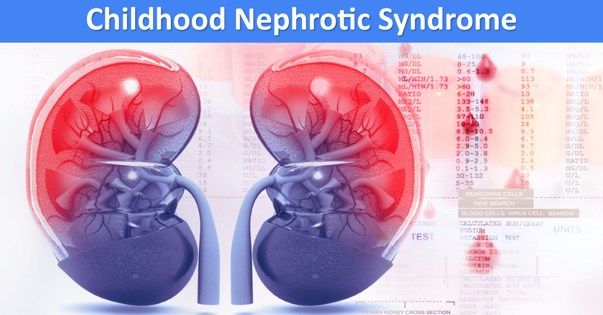 Treatment Options For Nephrotic Syndrome In Children