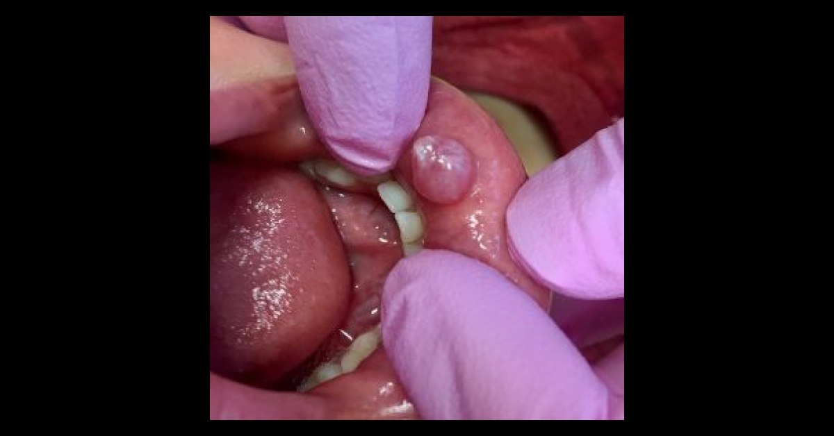 Solve This Case Of Sore Lip