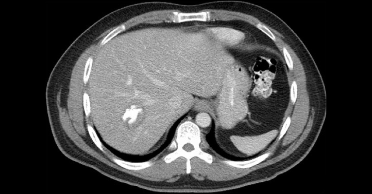 Diagnose From The CT Of Upper Abdomen