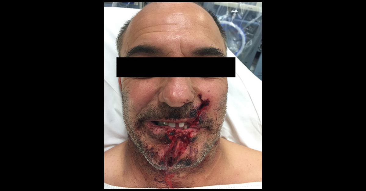 Construction Work Accident Victim