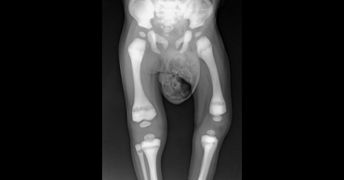 Identify This Bone Disorder