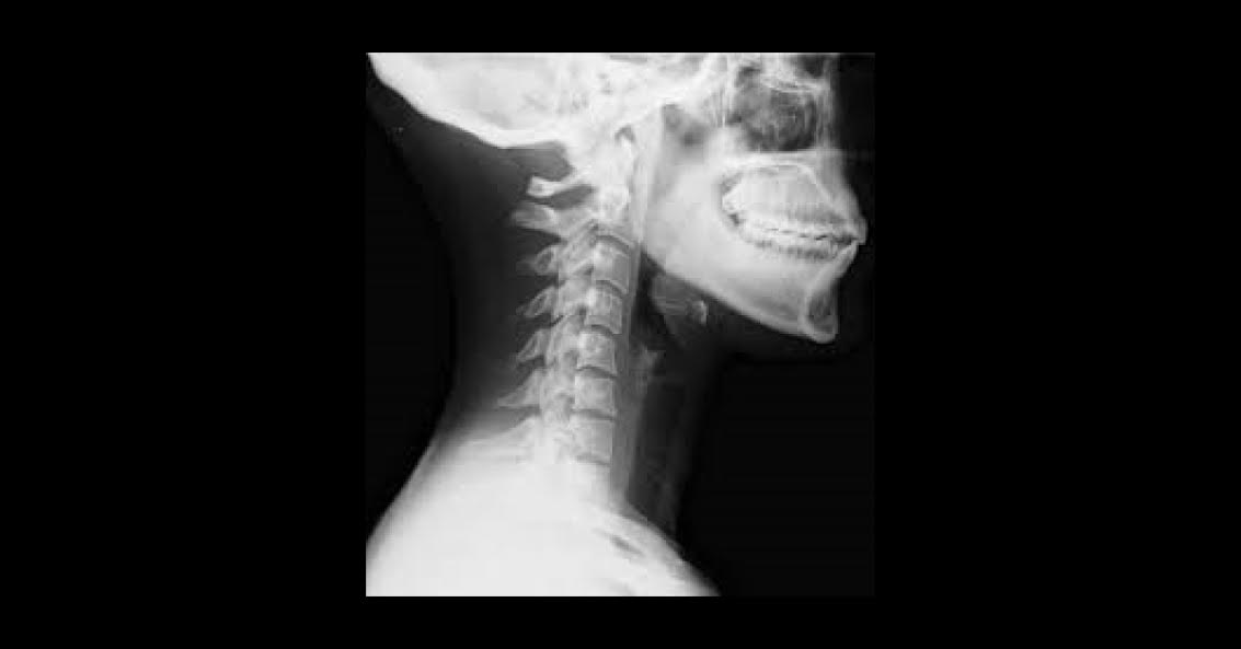 Case Of Klippel Feil Syndrome